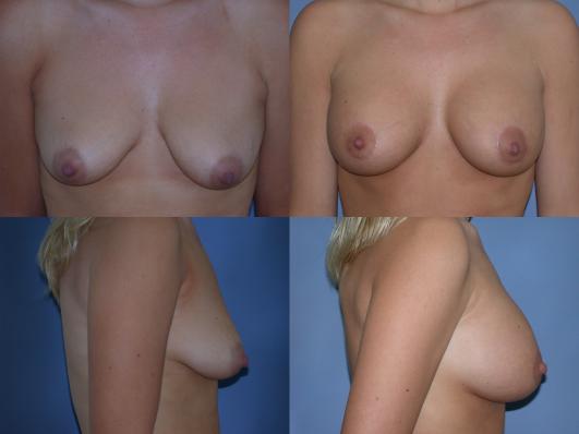 breast-augmentation-and-lift-p1.jpg