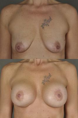 breast-augmentation-and-lift-p8.jpg