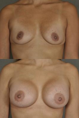 breast-augmentation-p2.jpg