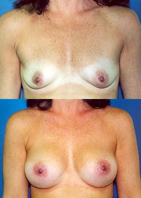 breast-augmentation-p21.jpg