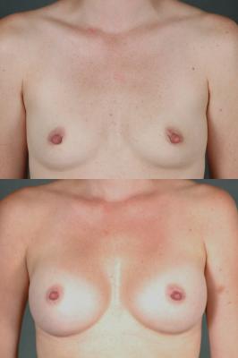 breast-augmentation-p23.jpg