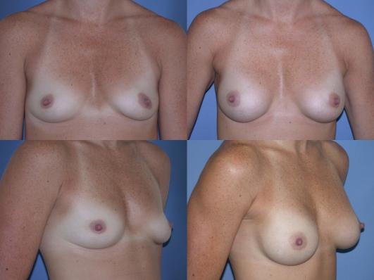 breast-augmentation-p26.jpg