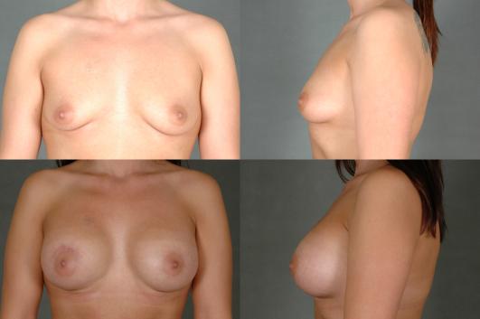 breast-augmentation-p30.jpg