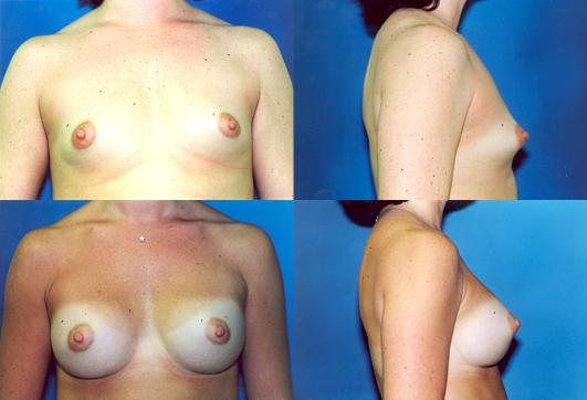 breast-augmentation-p38.jpg