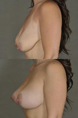 breast-lift-and-augmentation-p3_mp0YzG3.jpg