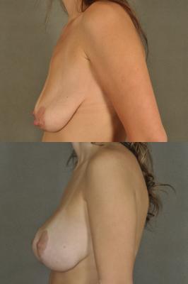 breast-lift-and-augmentation-p6_4hBBjPW.jpg