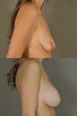 breast-lift-and-augmentation-p6_l12btq0.jpg