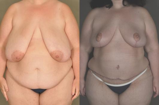 breast-lift-and-tummy-tuck-p1.jpg