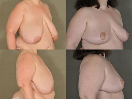 breast-lift-and-tummy-tuck-p1_0ehyygW.jpg