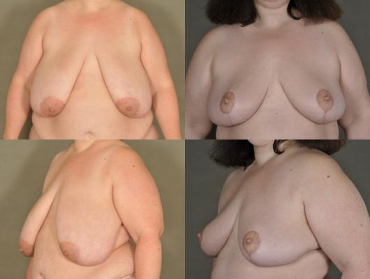 breast-lift-and-tummy-tuck-p1_7DHRKdJ.jpg