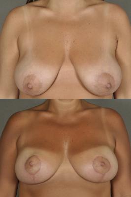 breast-lift-p2.jpg