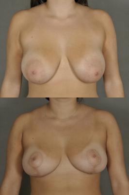 breast-lift-p4_UX9qTYn.jpg