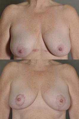 breast-lift-p5.jpg