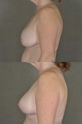 breast-lift-p5_BdguRTe.jpg
