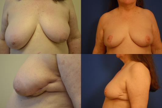 breast-reconstruction-and-scar-revision-g3_NCyVA7G.jpg
