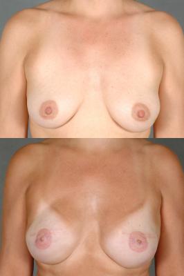 breast-reconstruction-and-tissue-expanders-lip-p20.jpg
