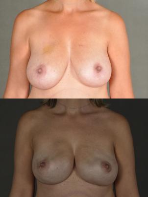 breast-reconstruction-and-tissue-expanders-p10.jpg