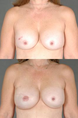 breast-reconstruction-and-tissue-expanders-p11.jpg