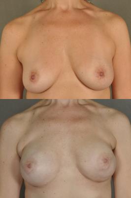 breast-reconstruction-and-tissue-expanders-p13.jpg