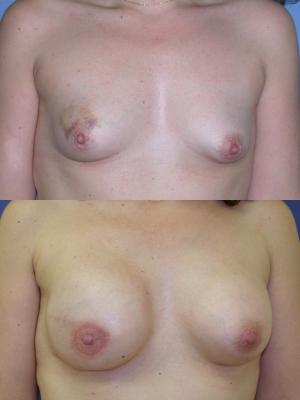 breast-reconstruction-and-tissue-expanders-p15.jpg