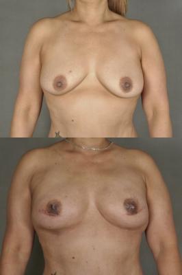 breast-reconstruction-and-tissue-expanders-p16_siKqEcI.jpg