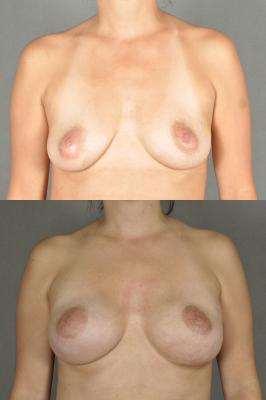breast-reconstruction-and-tissue-expanders-p19.jpg