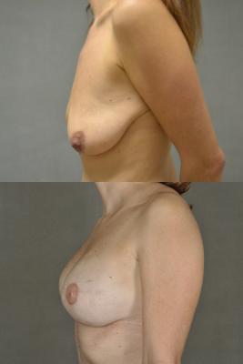 breast-reconstruction-and-tissue-expanders-p1_ZO19cWT.jpg