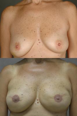 breast-reconstruction-and-tissue-expanders-p22.jpg