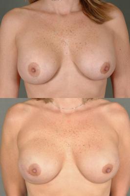 breast-reconstruction-and-tissue-expanders-p23.jpg