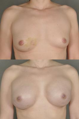breast-reconstruction-and-tissue-expanders-p25.jpg