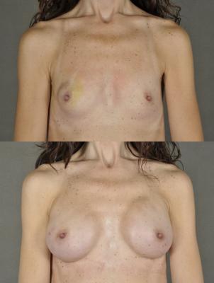 breast-reconstruction-and-tissue-expanders-p28.jpg