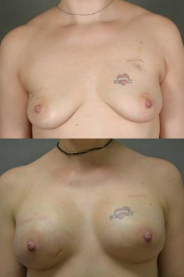 breast-reconstruction-and-tissue-expanders-p29.jpg
