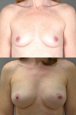 breast-reconstruction-and-tissue-expanders-p3.jpg