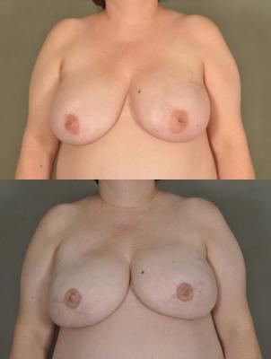 breast-reconstruction-and-tissue-expanders-p32.jpg