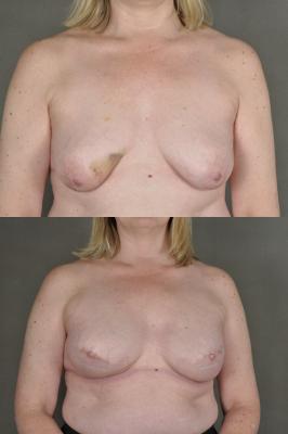 breast-reconstruction-and-tissue-expanders-p33.jpg