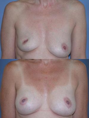 breast-reconstruction-and-tissue-expanders-p34.jpg