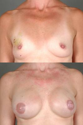 breast-reconstruction-and-tissue-expanders-p35_ScbB21T.jpg