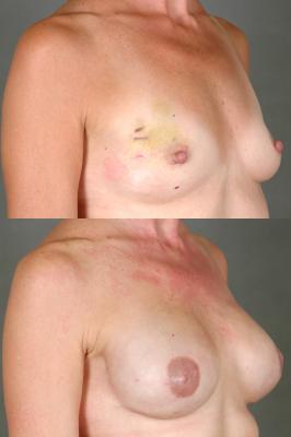 breast-reconstruction-and-tissue-expanders-p35_rbeF27D.jpg