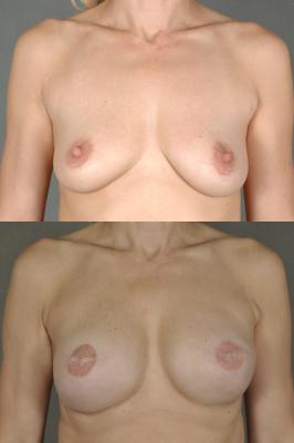 breast-reconstruction-and-tissue-expanders-p36_vRDy9qK.jpg