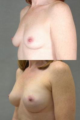 breast-reconstruction-and-tissue-expanders-p3_DH2xud2.jpg