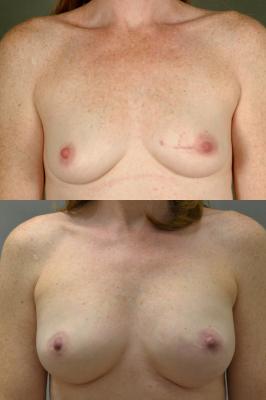 breast-reconstruction-and-tissue-expanders-p3_So2hQlp.jpg