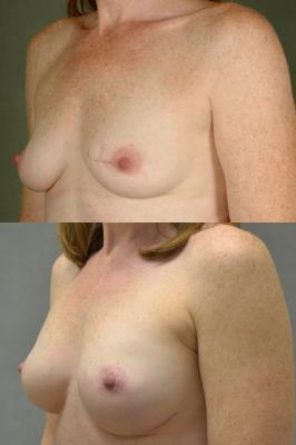 breast-reconstruction-and-tissue-expanders-p3_y0fbSDl.jpg
