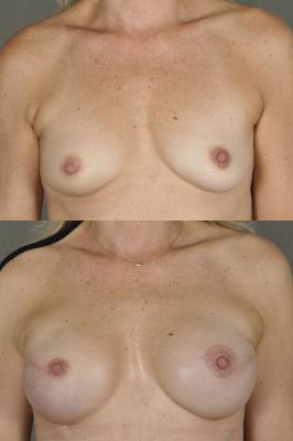 breast-reconstruction-and-tissue-expanders-p4.jpg