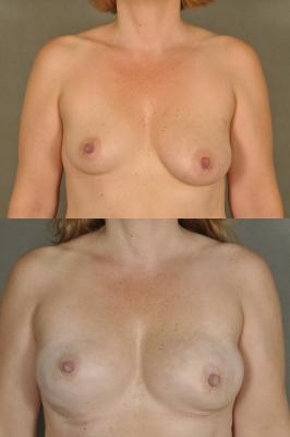 breast-reconstruction-and-tissue-expanders-p40.jpg