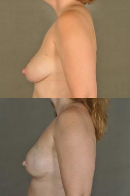 breast-reconstruction-and-tissue-expanders-p40_5rCTEoD.jpg