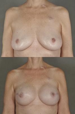 breast-reconstruction-and-tissue-expanders-p41.jpg