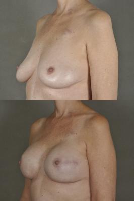 breast-reconstruction-and-tissue-expanders-p41_WSKOnku.jpg