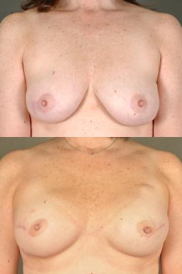 breast-reconstruction-and-tissue-expanders-p42.jpg