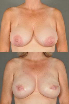 breast-reconstruction-and-tissue-expanders-p43.jpg