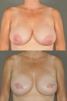 breast-reconstruction-and-tissue-expanders-p43_mpiqgOM.jpg